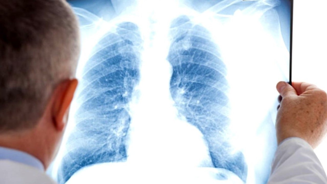 Uzmanlar uyarıyor: Her yıl 3,5 milyon can alıyor! Belirti görmezden gelinince ölüme götürüyor