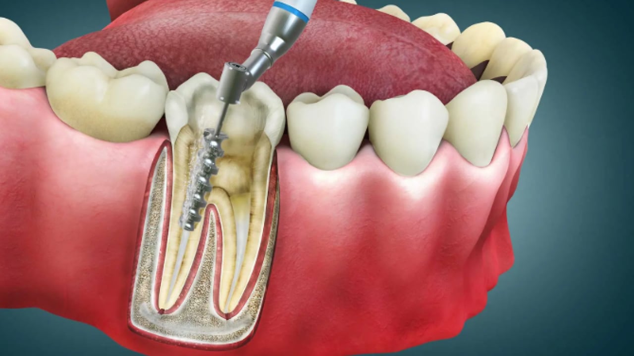 Foto - Uzmanlardan önemli uyarı: Kanal tedavisi ihmali kistlere yol açabilir