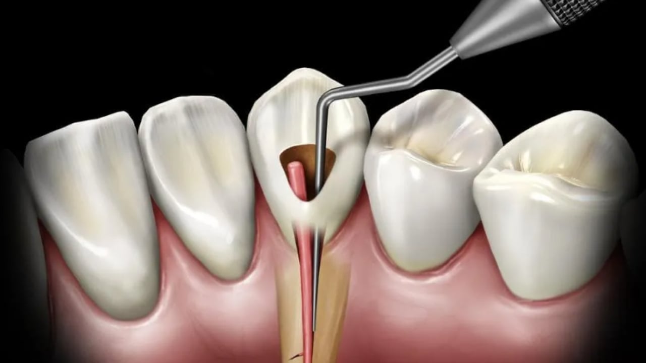 Foto - Uzmanlardan önemli uyarı: Kanal tedavisi ihmali kistlere yol açabilir