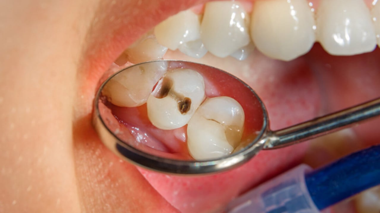 Foto - Uzmanlardan önemli uyarı: Kanal tedavisi ihmali kistlere yol açabilir