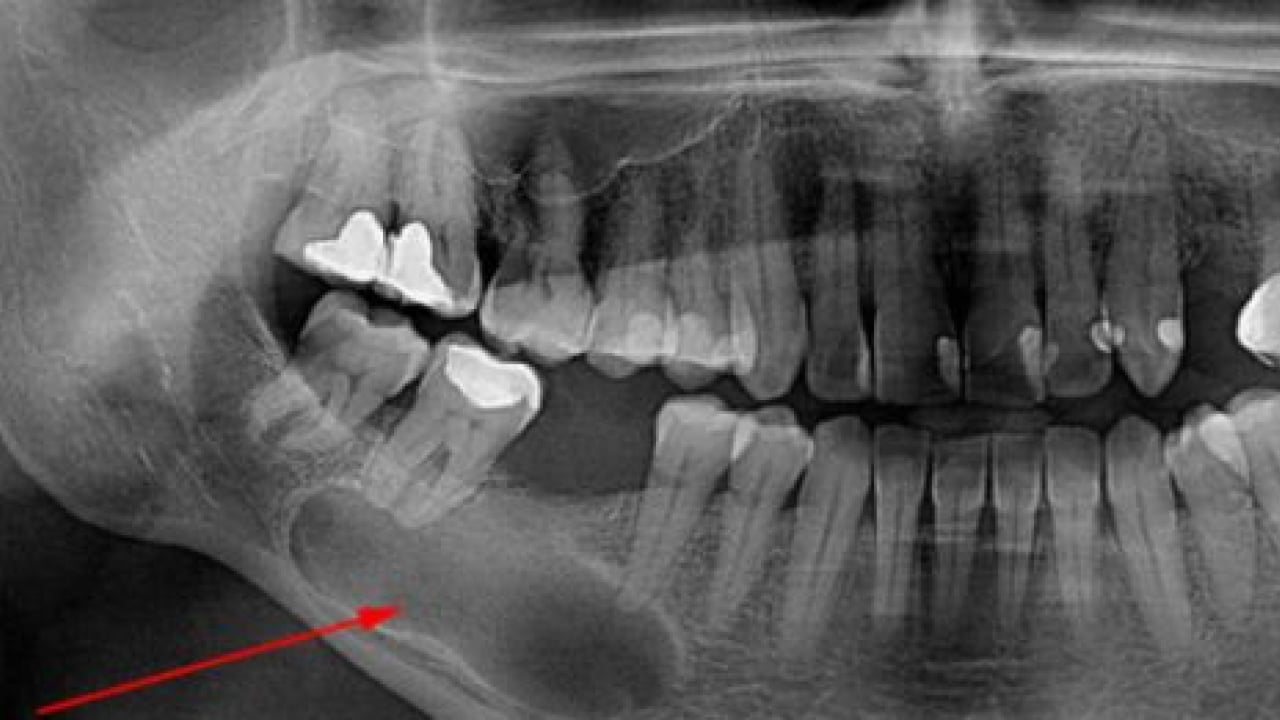 Foto - Uzmanlardan önemli uyarı: Kanal tedavisi ihmali kistlere yol açabilir