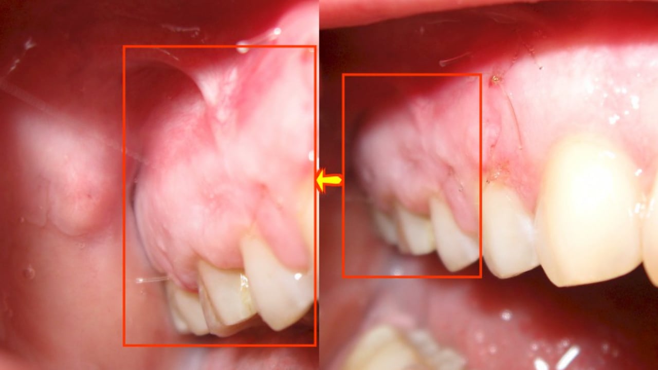 Foto - Uzmanlardan önemli uyarı: Kanal tedavisi ihmali kistlere yol açabilir