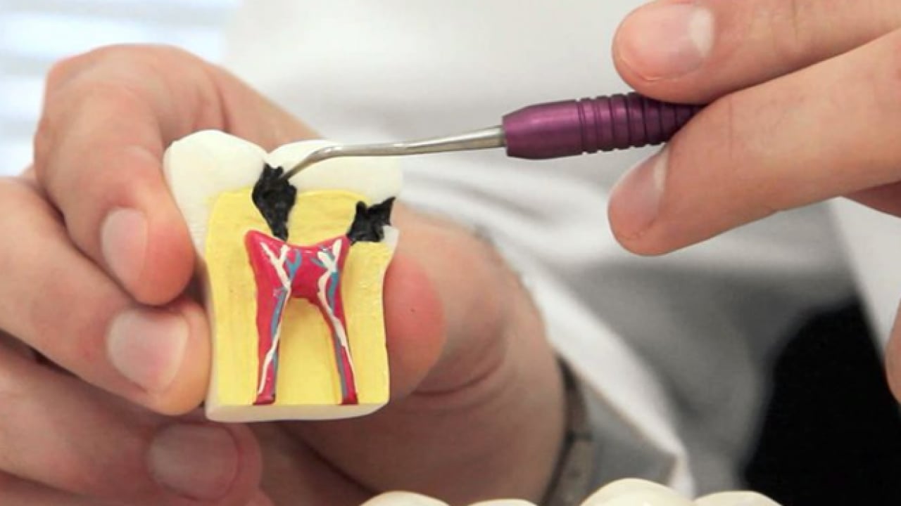 Foto - Uzmanlardan önemli uyarı: Kanal tedavisi ihmali kistlere yol açabilir