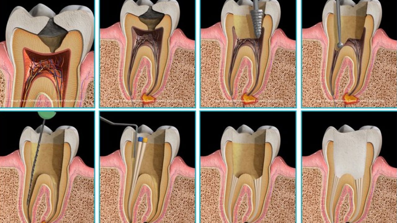 Foto - Uzmanlardan önemli uyarı: Kanal tedavisi ihmali kistlere yol açabilir
