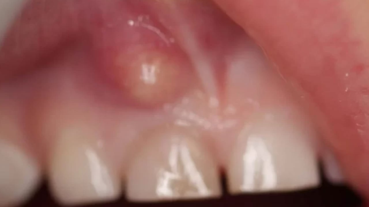 Foto - Uzmanlardan önemli uyarı: Kanal tedavisi ihmali kistlere yol açabilir