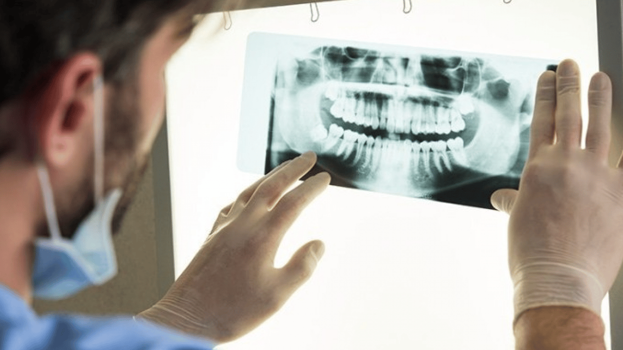 Uzmanlardan önemli uyarı: Kanal tedavisi ihmali kistlere yol açabilir