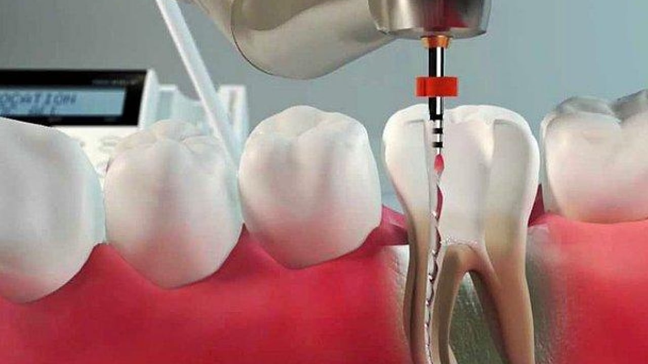 Foto - Uzmanlardan önemli uyarı: Kanal tedavisi ihmali kistlere yol açabilir