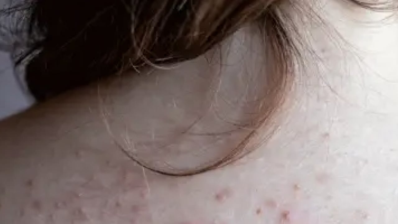 Foto - Uzun süren ve açıklanamayan cilt değişiklikleri karaciğer hastalıklarının habercisi olabilir! Uzman isim uyardı