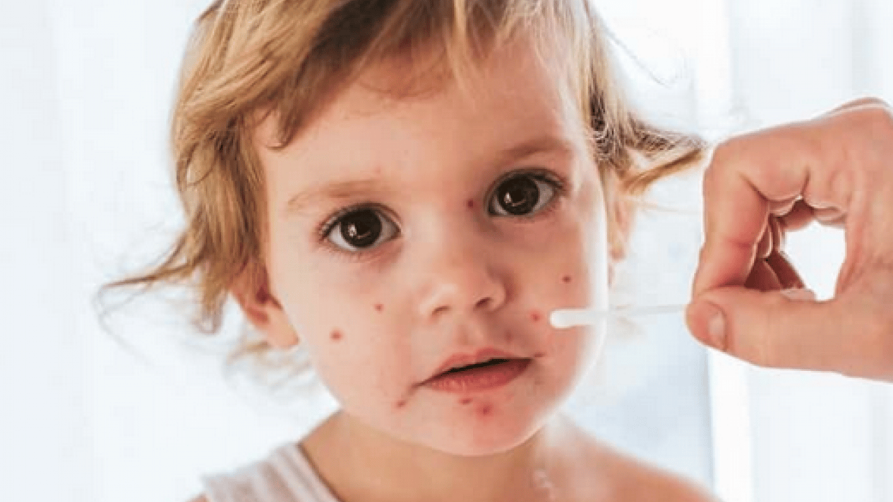 Foto - Varicella Zoster Virüsü çağrısı geldi! Zayıf bağışıklık ve stres dönemlerinde...