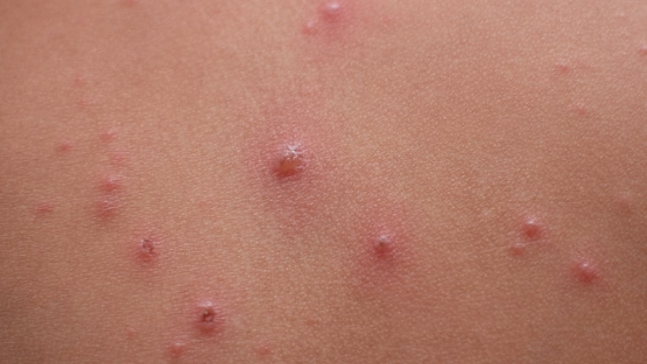 Foto - Varicella Zoster Virüsü çağrısı geldi! Zayıf bağışıklık ve stres dönemlerinde...