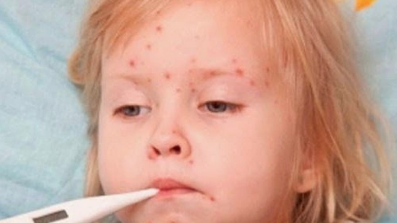 Foto - Varicella Zoster Virüsü çağrısı geldi! Zayıf bağışıklık ve stres dönemlerinde...