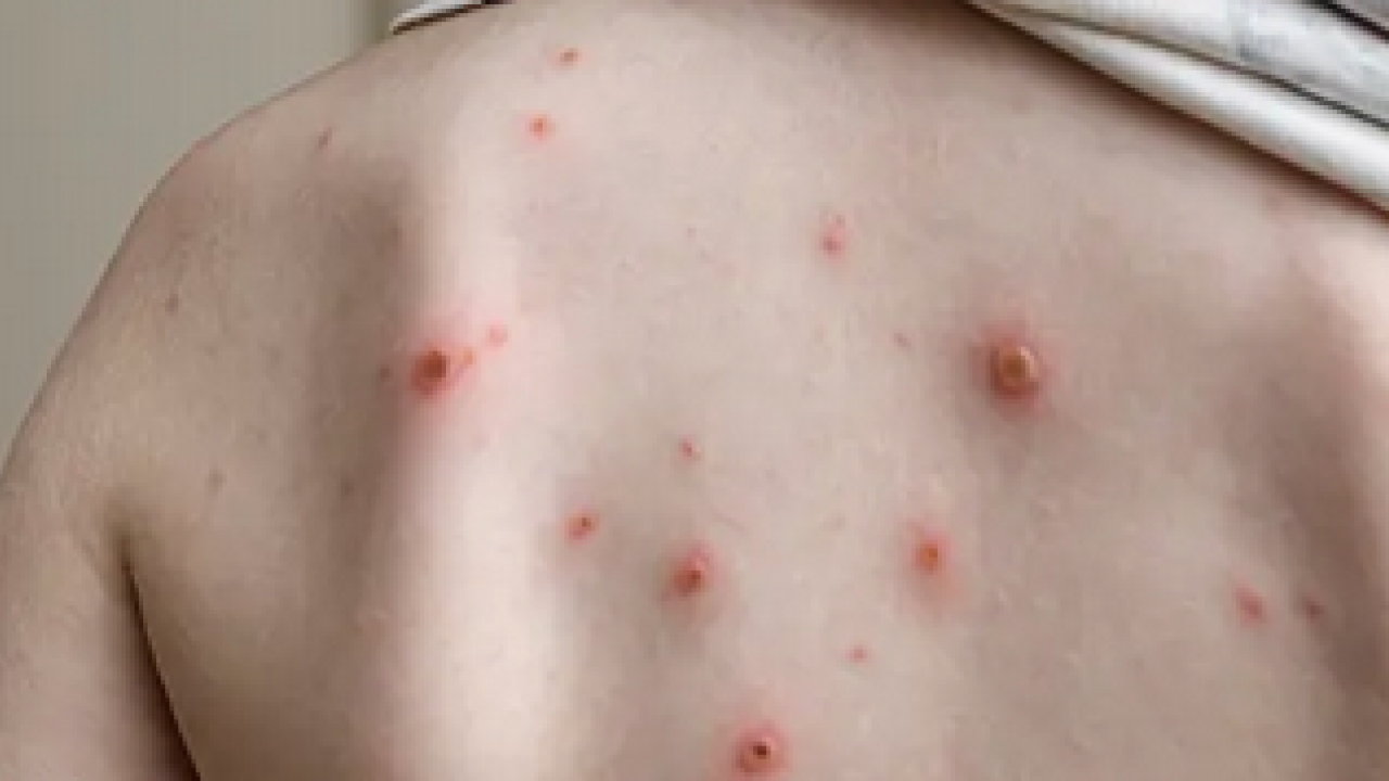 Foto - Varicella Zoster Virüsü çağrısı geldi! Zayıf bağışıklık ve stres dönemlerinde...