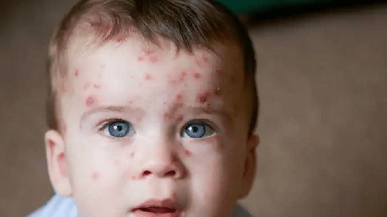 Foto - Varicella Zoster Virüsü çağrısı geldi! Zayıf bağışıklık ve stres dönemlerinde...