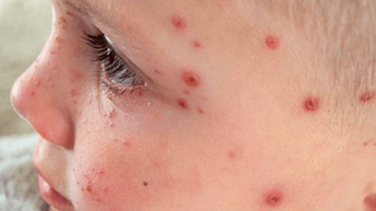 Foto - Varicella Zoster Virüsü çağrısı geldi! Zayıf bağışıklık ve stres dönemlerinde...