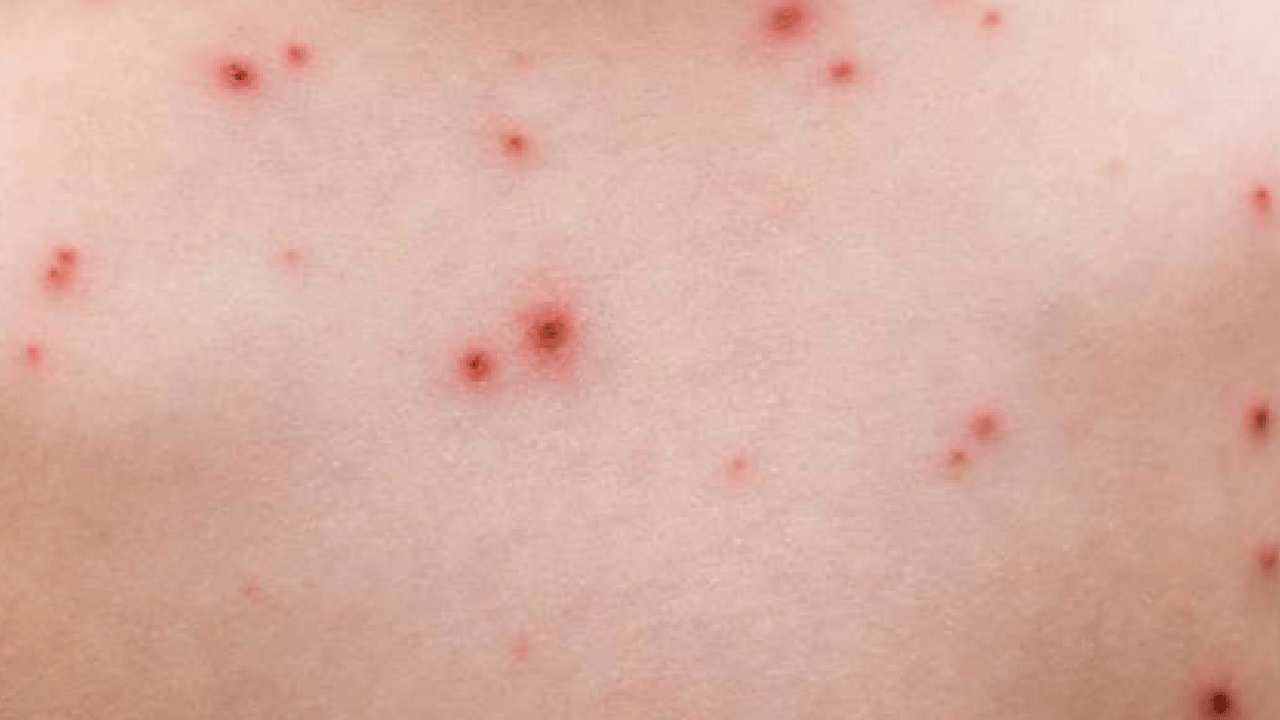 Varicella Zoster Virüsü çağrısı geldi! Zayıf bağışıklık ve stres dönemlerinde...