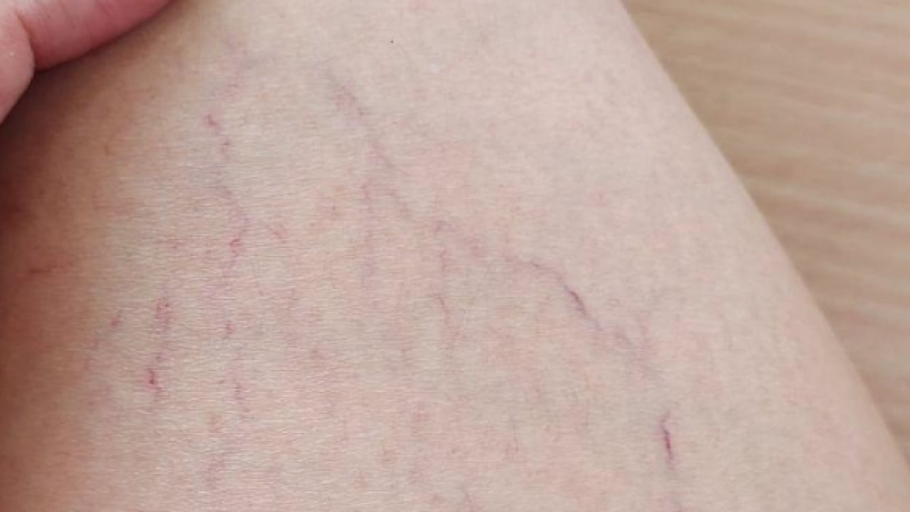 Foto - Varisle karıştırılan ödem farklı hastalıkların habercisi olabilir! Saniyeler içinde...