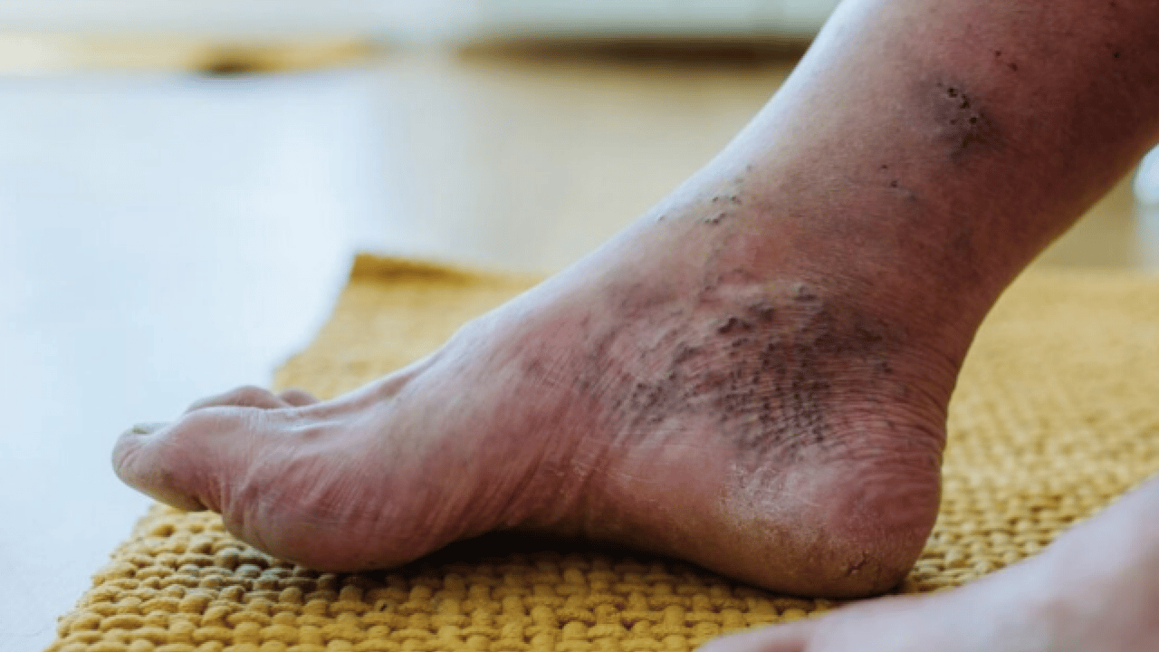 Foto - Varisle karıştırılan ödem farklı hastalıkların habercisi olabilir! Saniyeler içinde...