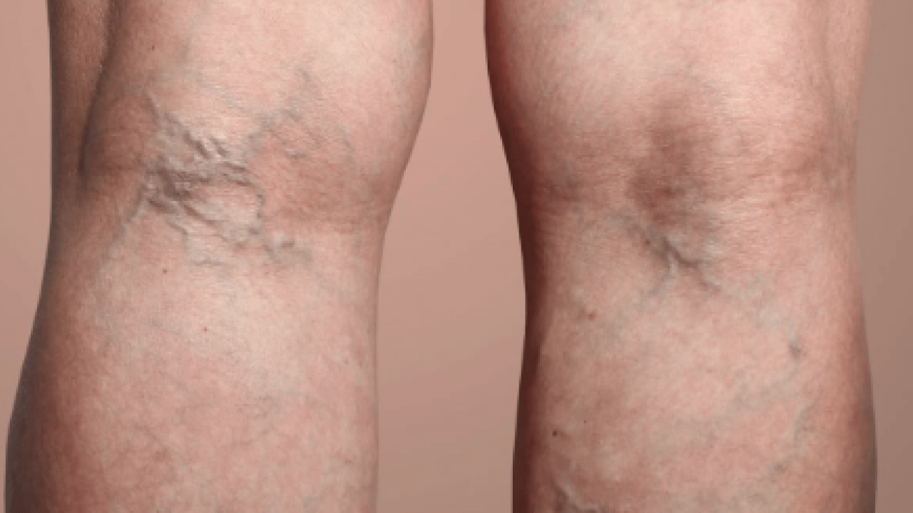 Varisle karıştırılan ödem farklı hastalıkların habercisi olabilir! Saniyeler içinde...