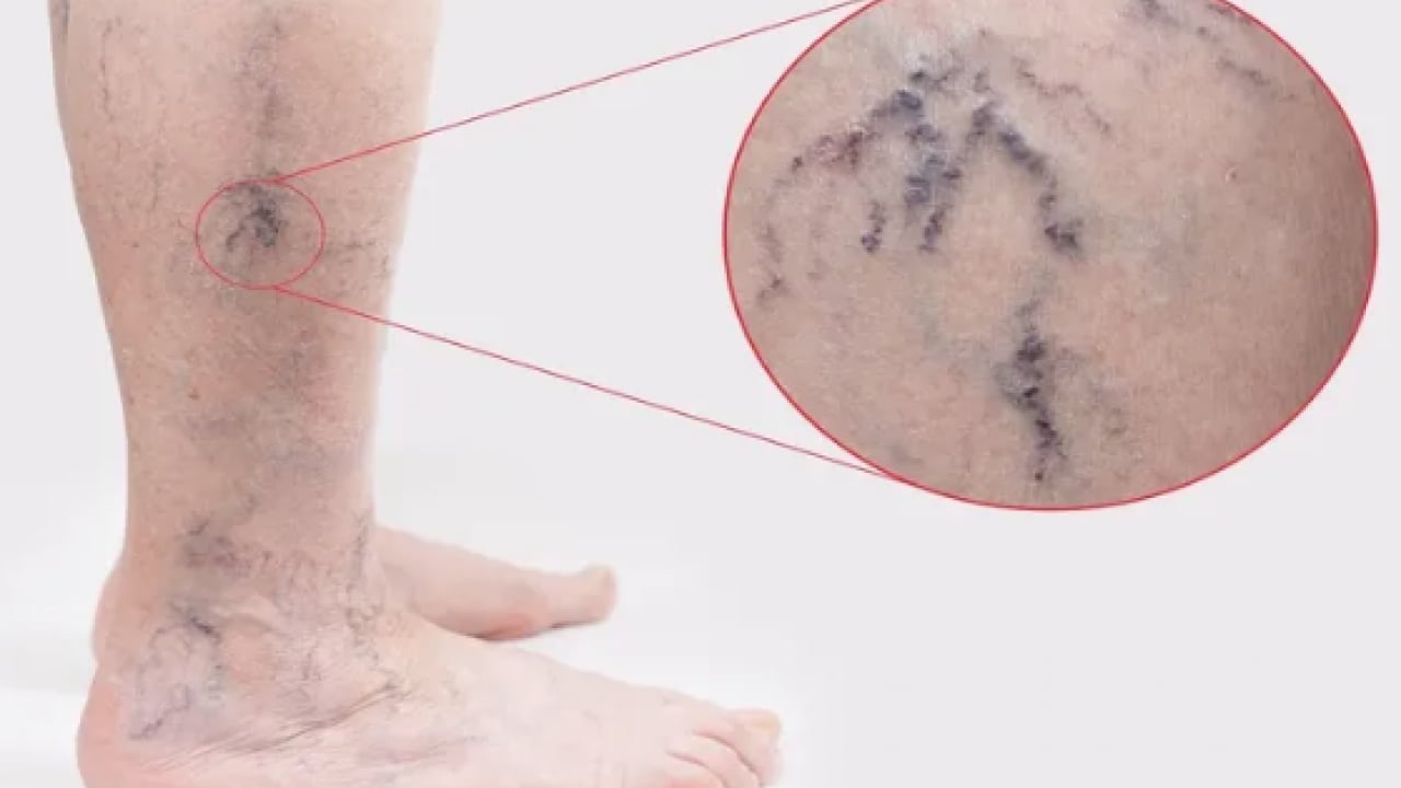 Foto - Varisle karıştırılan ödem farklı hastalıkların habercisi olabilir! Saniyeler içinde...