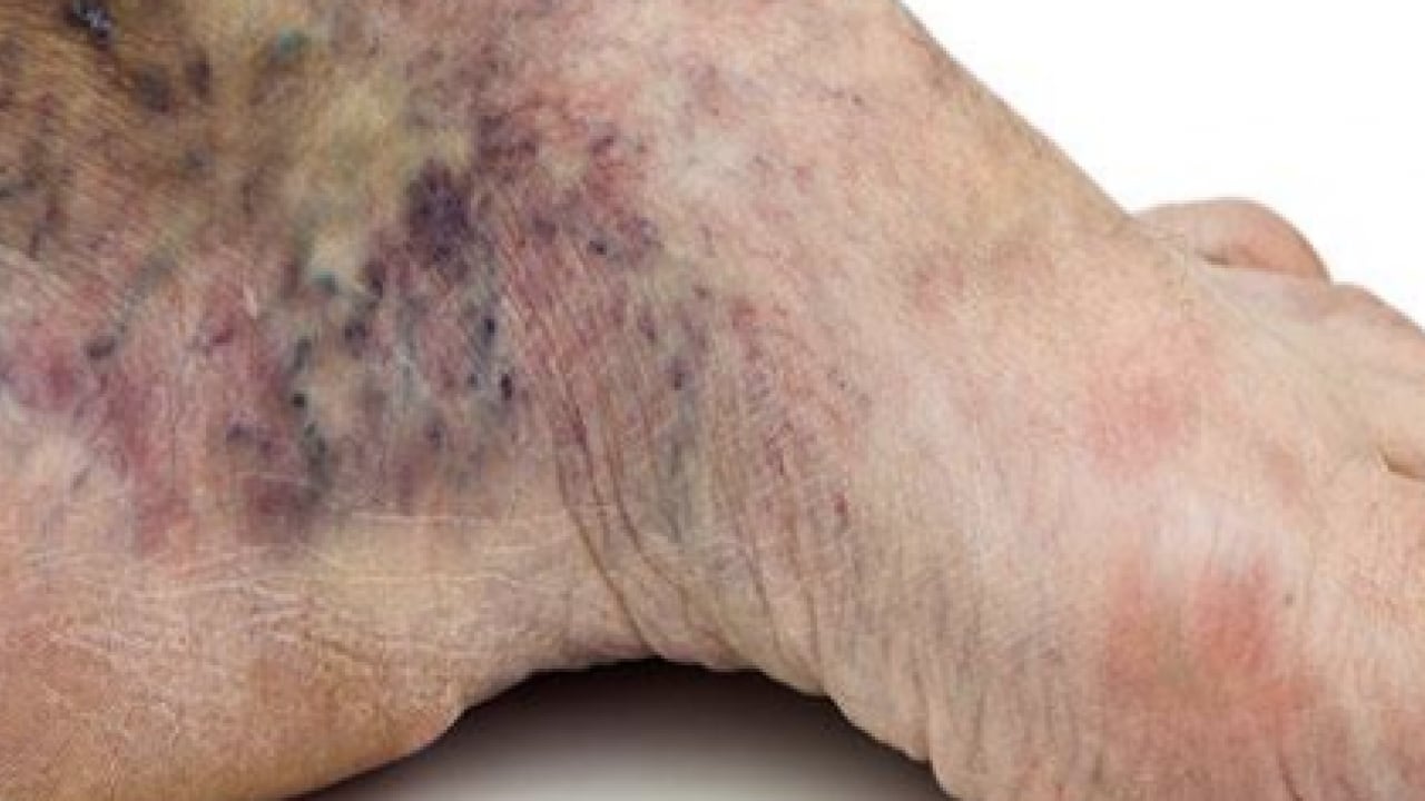 Foto - Varisle karıştırılan ödem farklı hastalıkların habercisi olabilir! Saniyeler içinde...