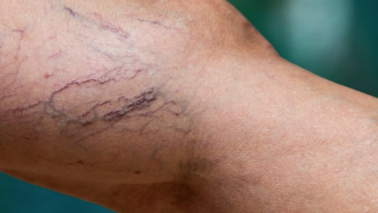 Foto - Varisle karıştırılan ödem farklı hastalıkların habercisi olabilir! Saniyeler içinde...