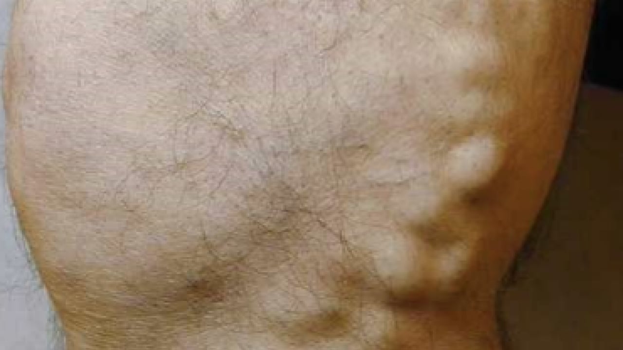 Foto - Varisle karıştırılan ödem farklı hastalıkların habercisi olabilir! Saniyeler içinde...