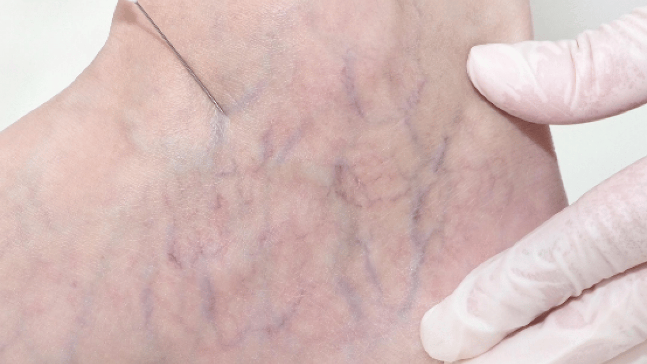 Foto - Varisle karıştırılan ödem farklı hastalıkların habercisi olabilir! Saniyeler içinde...