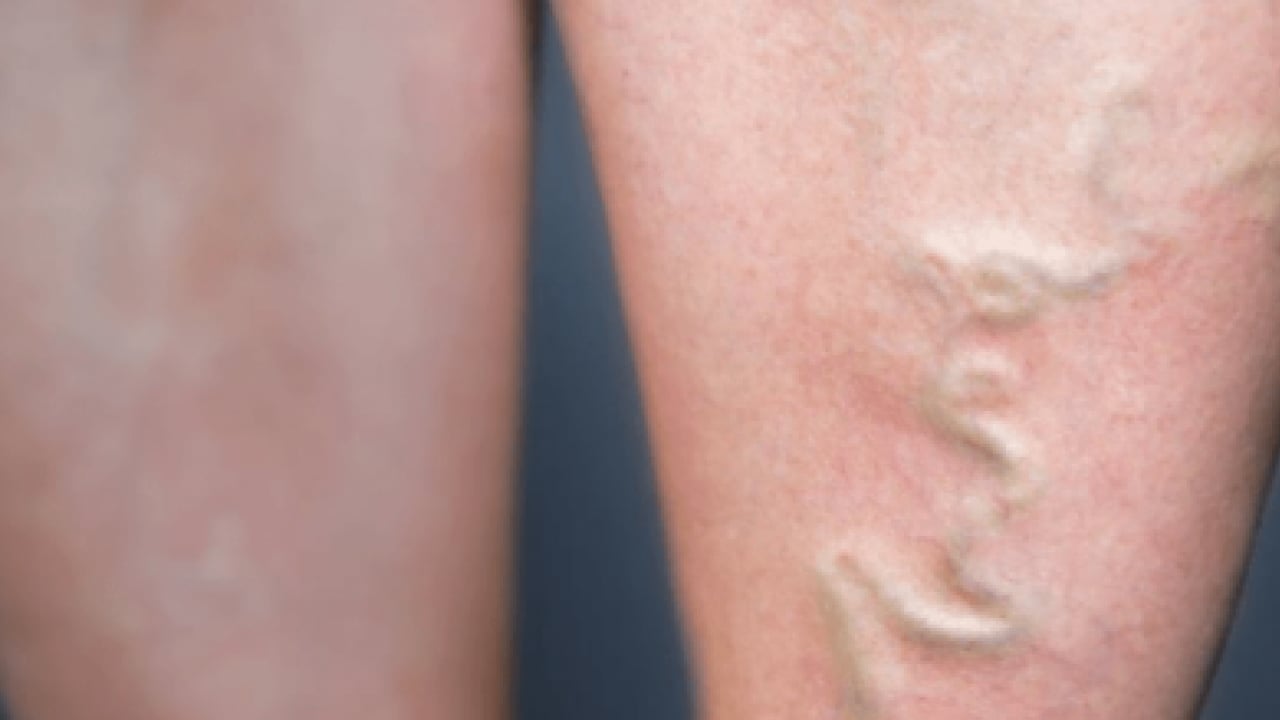 Foto - Varisle karıştırılan ödem farklı hastalıkların habercisi olabilir! Saniyeler içinde...