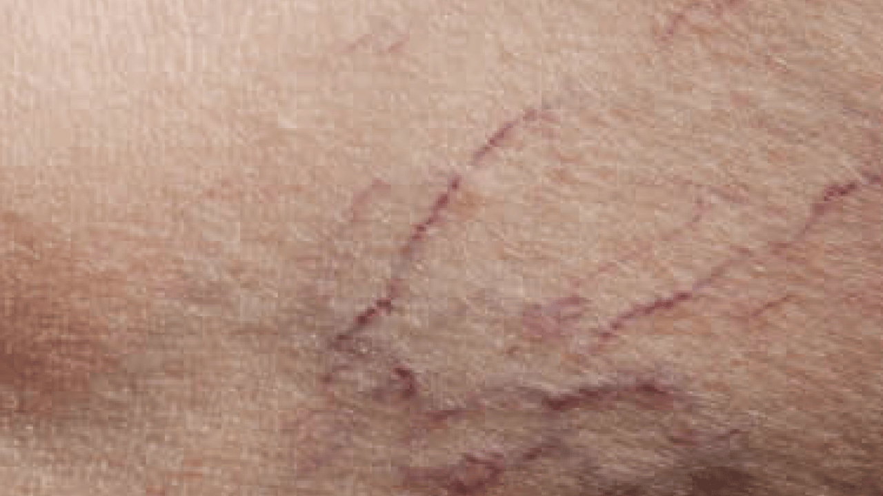 Foto - Varisle karıştırılan ödem farklı hastalıkların habercisi olabilir! Saniyeler içinde...