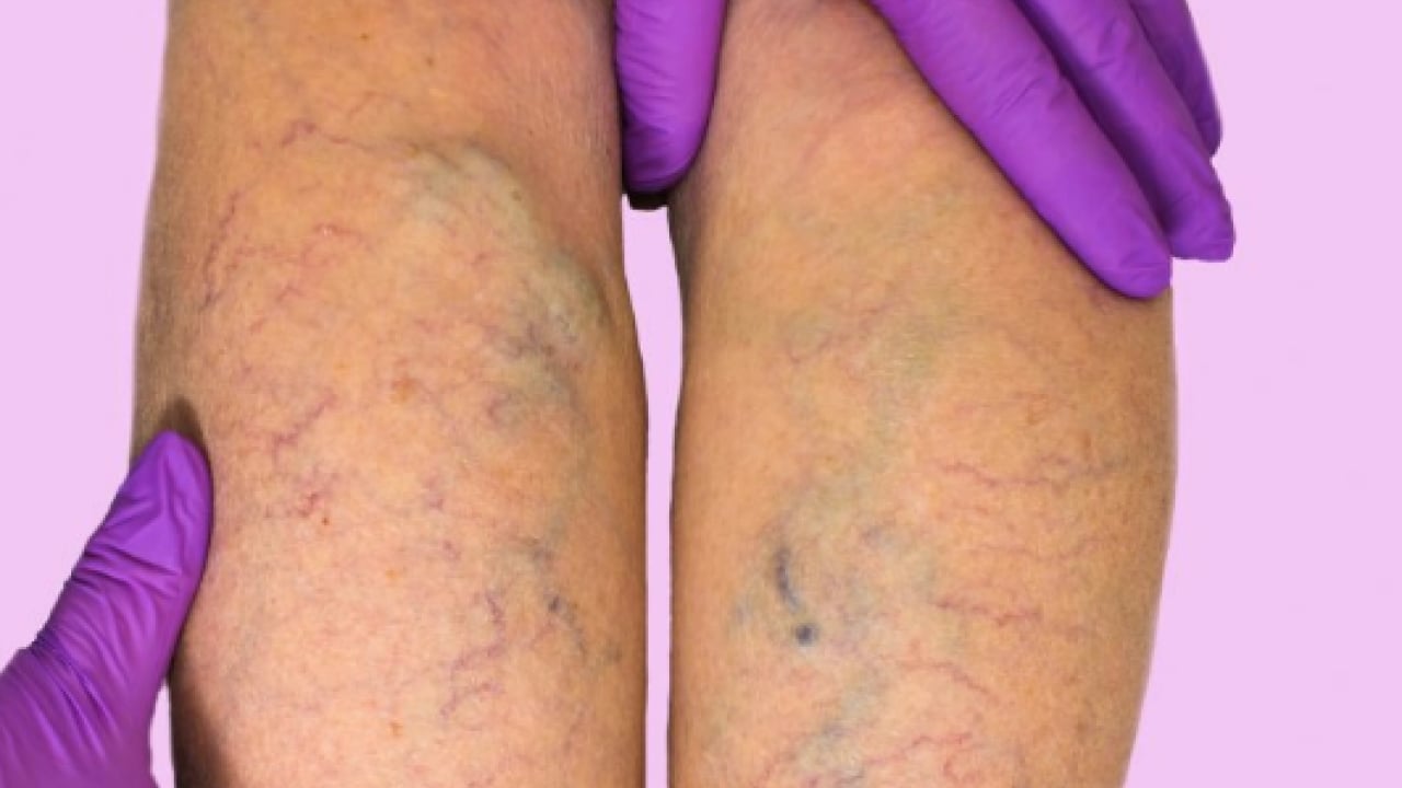 Foto - Varisle karıştırılan ödem farklı hastalıkların habercisi olabilir! Saniyeler içinde...