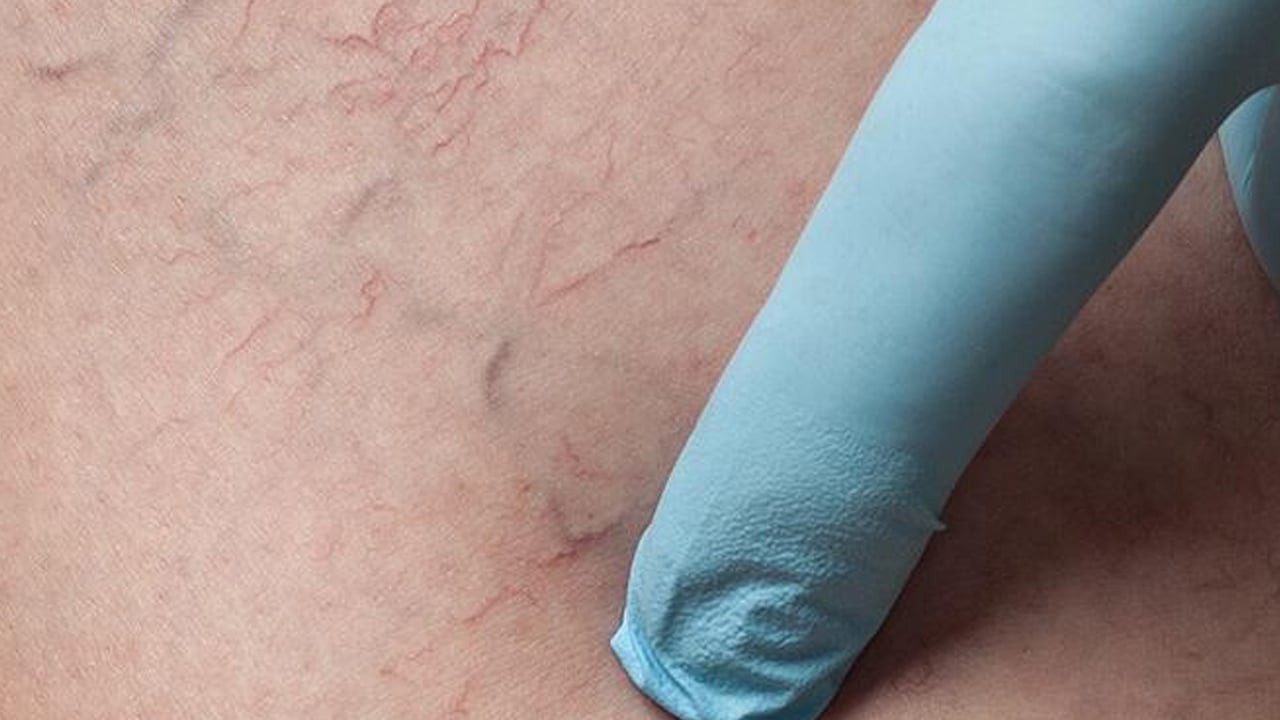 Varisli damarlardan sonsuza dek kurtaran karışım: Ayak için sıcak mı soğuk su mu kullanılır? Fayda etti