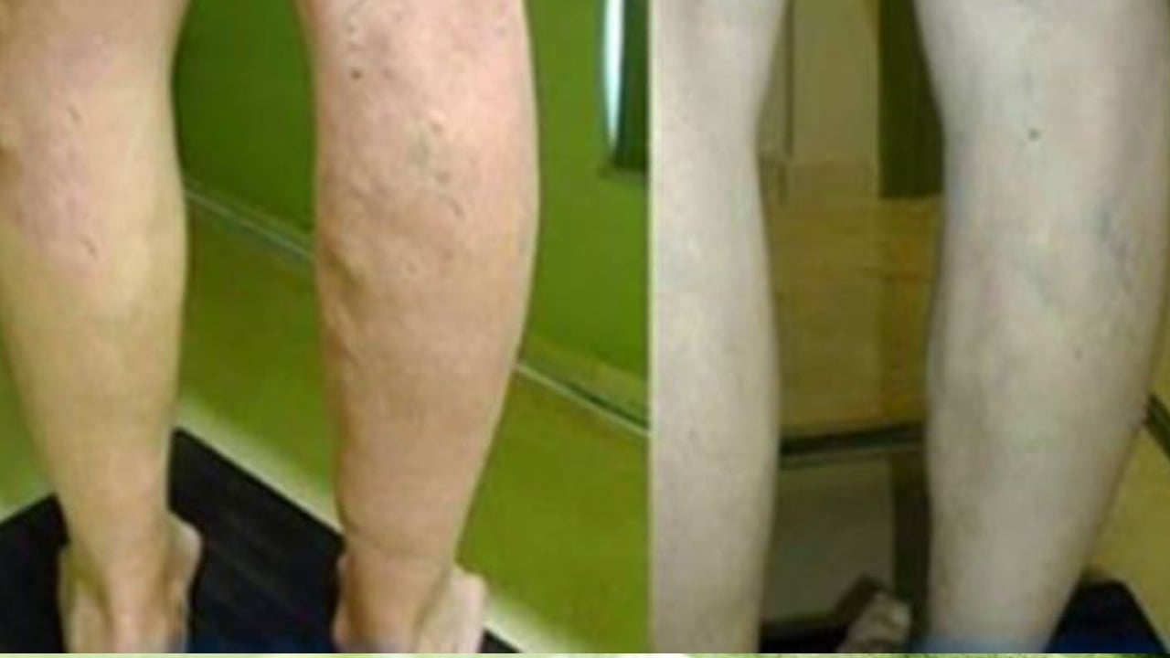 Foto - Varisli damarlardan sonsuza dek kurtaran karışım: Ayak için sıcak mı soğuk su mu kullanılır? Fayda etti