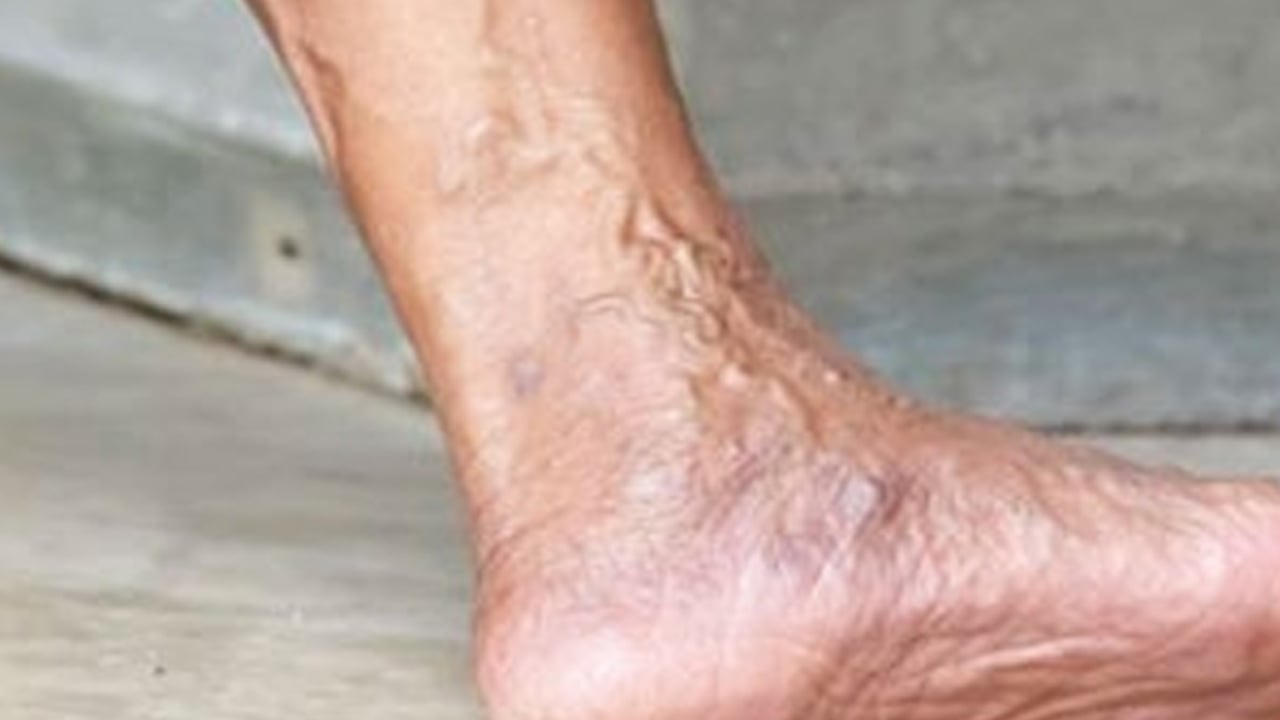 Foto - Varisli damarlardan sonsuza dek kurtaran karışım: Ayak için sıcak mı soğuk su mu kullanılır? Fayda etti