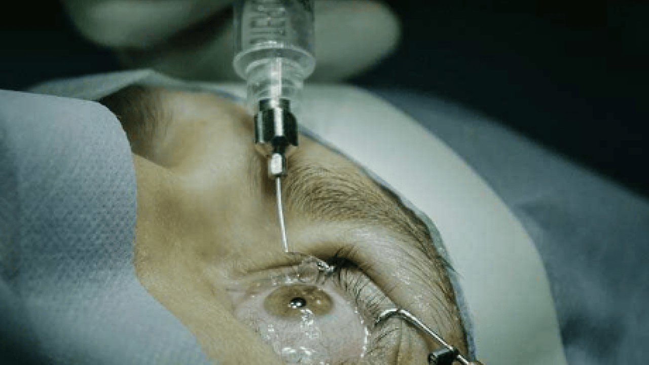 Foto - Vitrektomi ne işe yarar! Retina yırtıkları veya dekolmanı önemli...