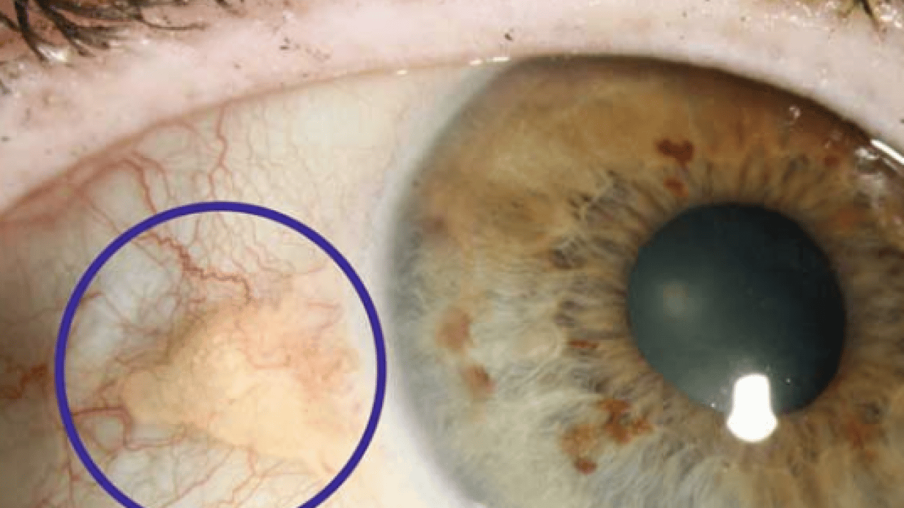 Vitrektomi ne işe yarar! Retina yırtıkları veya dekolmanı önemli...