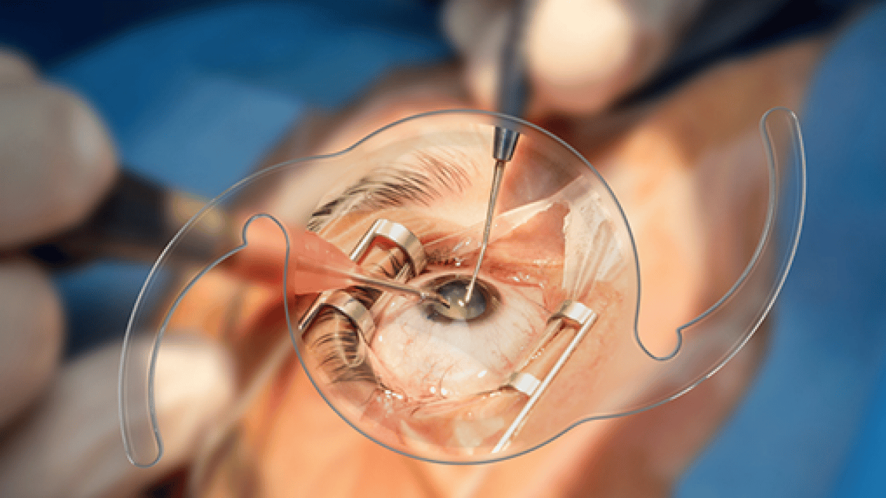 Foto - Vitrektomi ne işe yarar! Retina yırtıkları veya dekolmanı önemli...