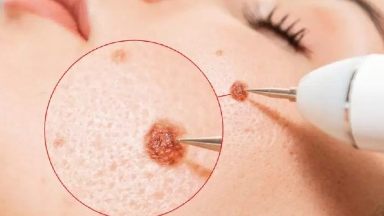 Foto - Vücudunda et beni olanlar dikkat! O hastalıkların habercisi olabilir