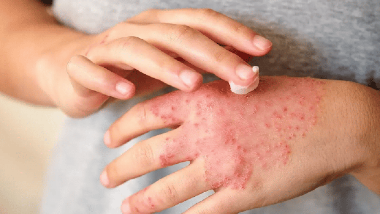 Foto - Vücudunuzda dengeleri değiştirecek müdahaleyi yapın: Meğer egzama yapıyor, pullanmayı çoğaltıyormuş