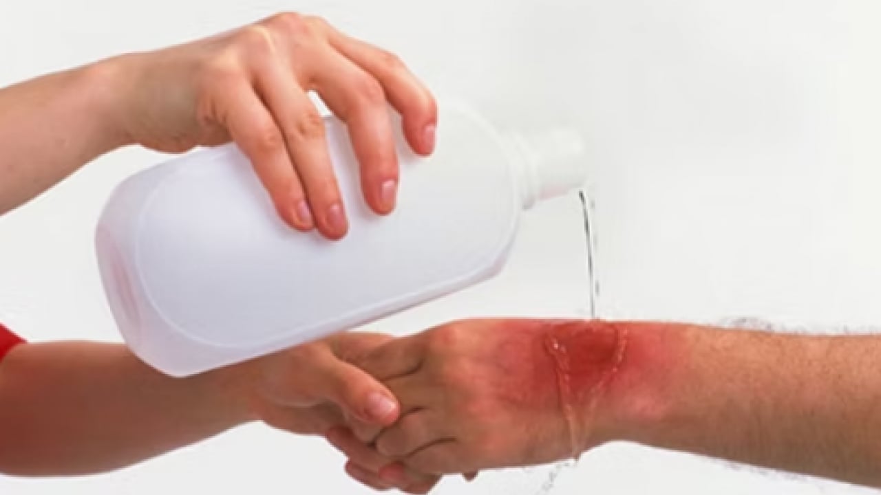 Foto - Yanık tedavisinde yeni dönem: Hedef ilk müdahalede hatasız uygulama