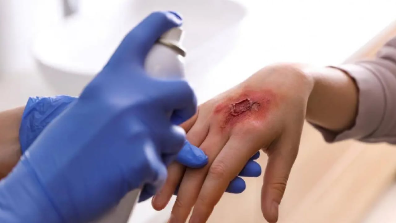 Foto - Yanık tedavisinde yeni dönem: Hedef ilk müdahalede hatasız uygulama