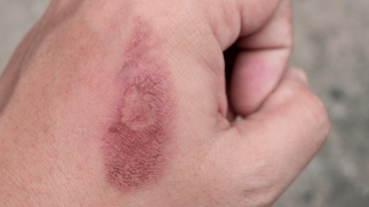 Foto - Yaraya yağ sürülür mü? İşte yanıklara iyi gelen 3 yağ! Dermatoloji uzmanı açıkladı