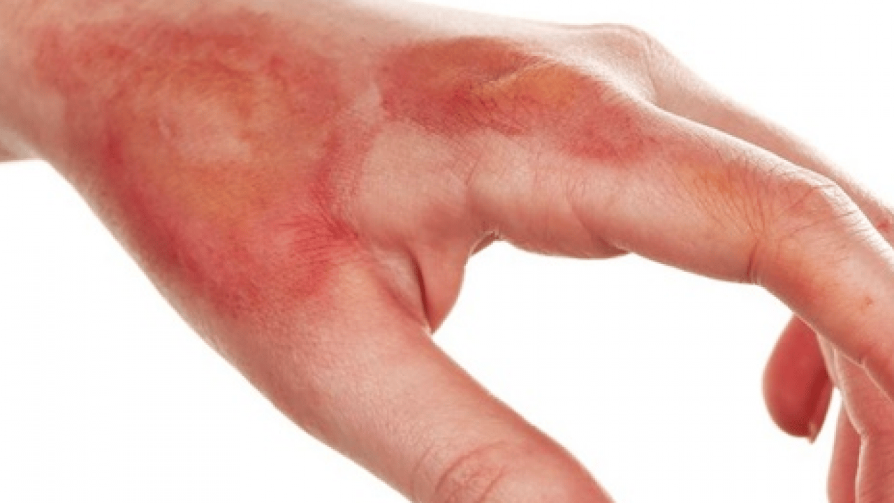 Foto - Yaraya yağ sürülür mü? İşte yanıklara iyi gelen 3 yağ! Dermatoloji uzmanı açıkladı