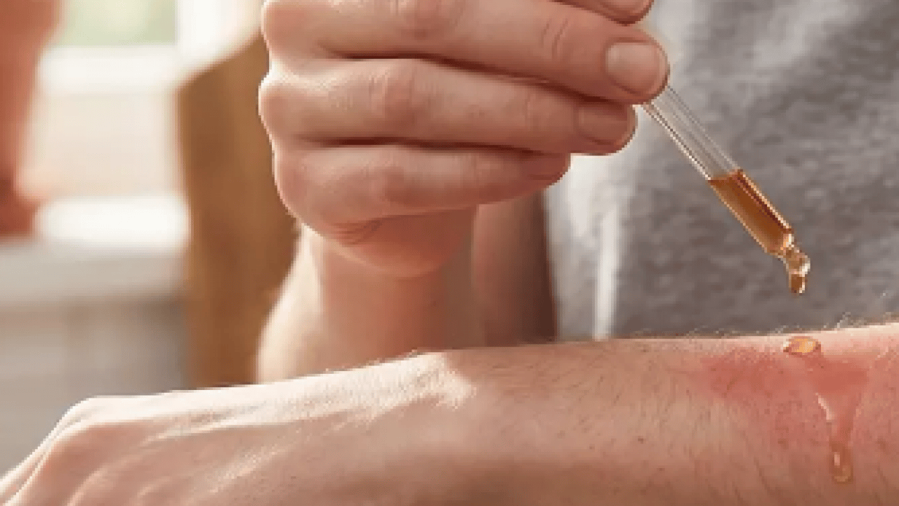 Foto - Yaraya yağ sürülür mü? İşte yanıklara iyi gelen 3 yağ! Dermatoloji uzmanı açıkladı