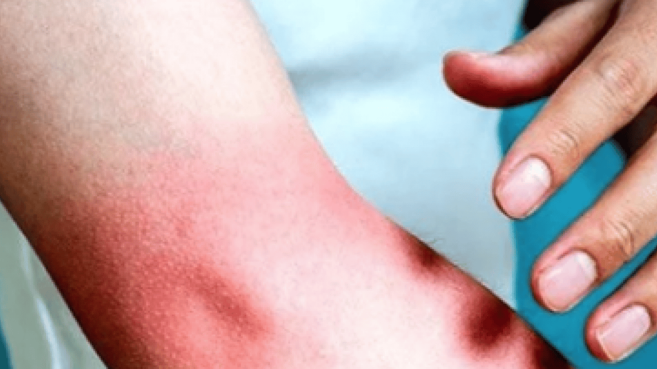 Foto - Yaraya yağ sürülür mü? İşte yanıklara iyi gelen 3 yağ! Dermatoloji uzmanı açıkladı