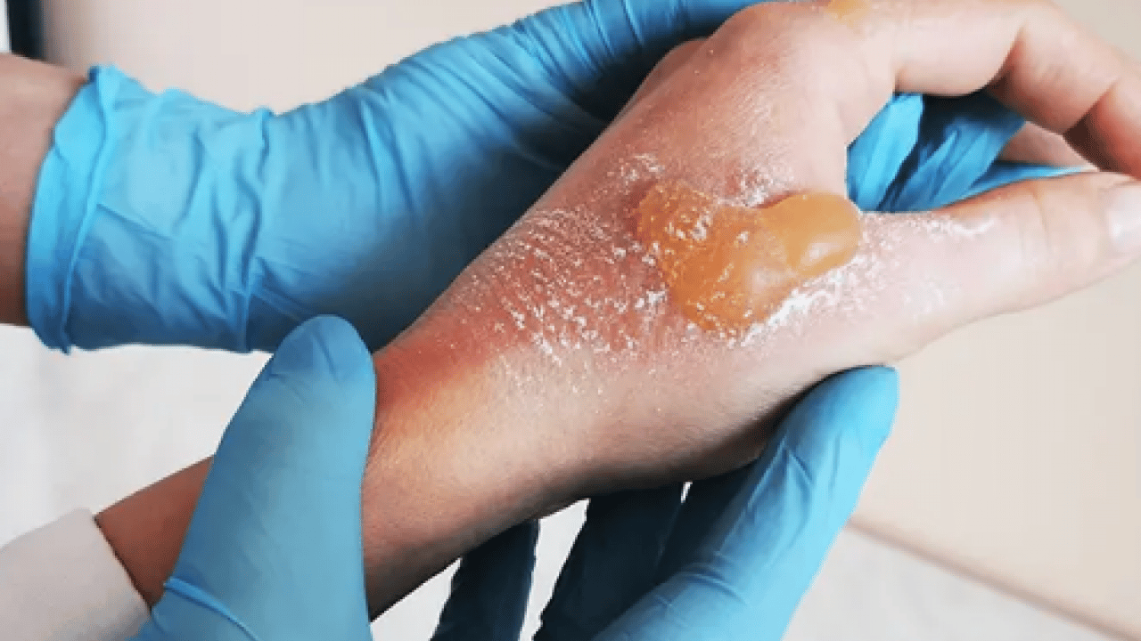 Foto - Yaraya yağ sürülür mü? İşte yanıklara iyi gelen 3 yağ! Dermatoloji uzmanı açıkladı