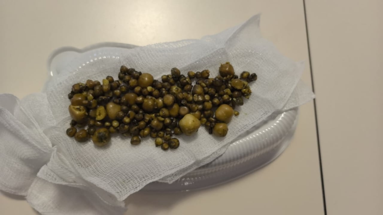 Foto - Yaşlı kadını apar topar ameliyata aldılar! Doktorlar bile gözlerine inanamadı: Tam 213 tane