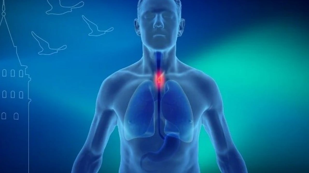 Foto - Yemek borusu kanserine dikkat!