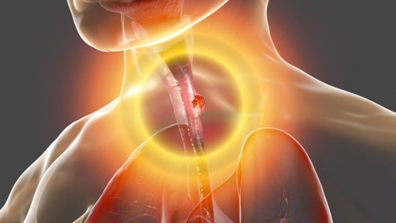 Foto - Yemek borusu kanserine dikkat!