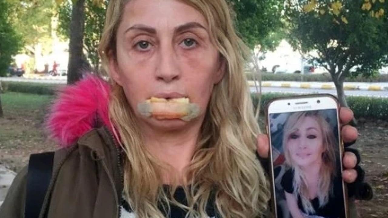 Foto - Yemek bile artık problem! Dolgu dudak hayat kararttı