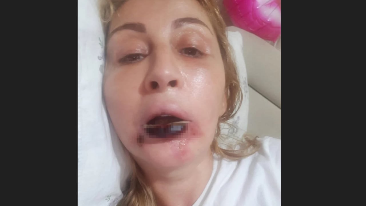 Foto - Yemek bile artık problem! Dolgu dudak hayat kararttı
